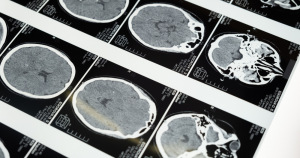 Read more about the article The Aftermath of War: Traumatic Brain Injury