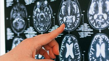 Breakthrough TBI Treatment: Healing Invisible Wounds