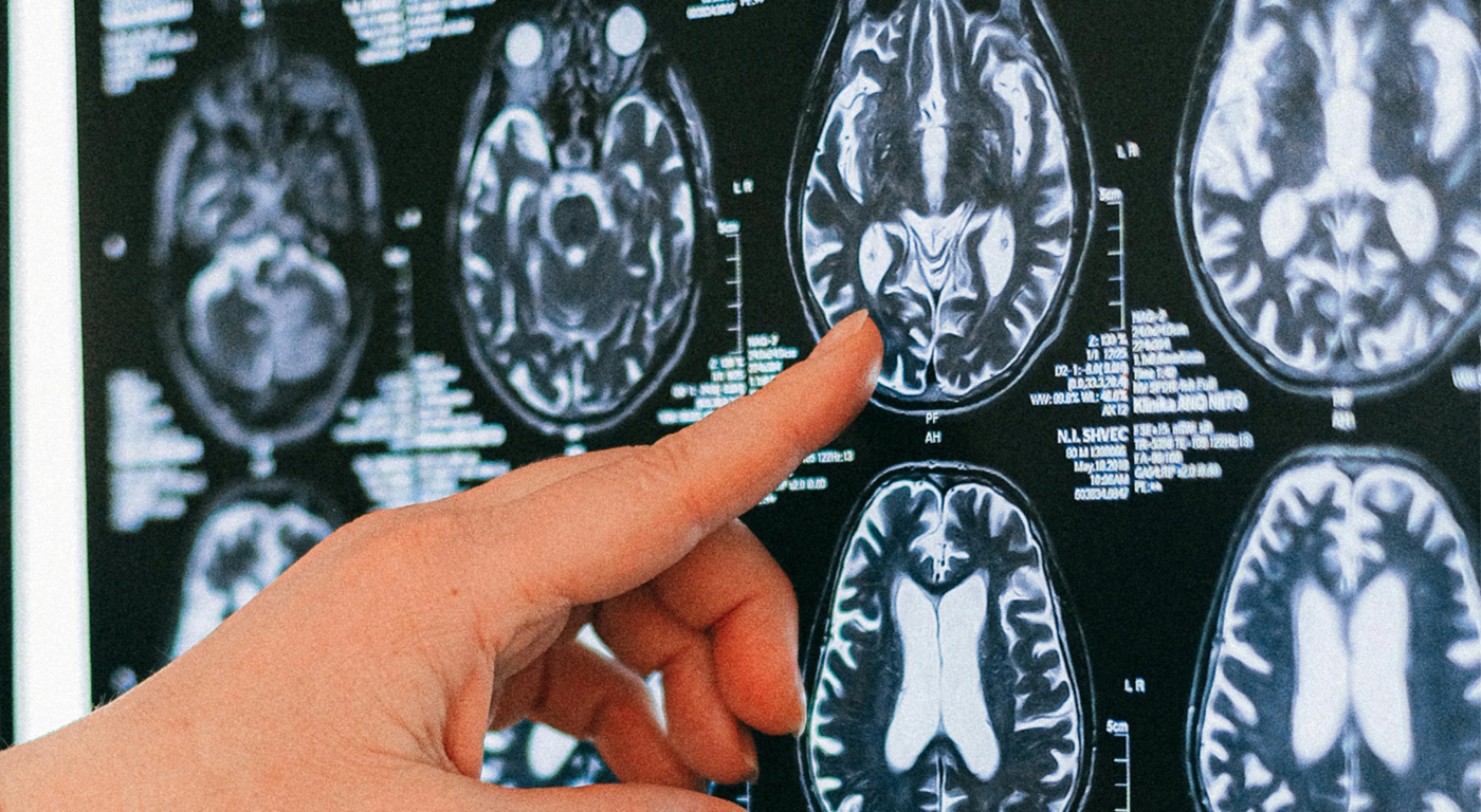 You are currently viewing Breakthrough TBI Treatment: Healing Invisible Wounds